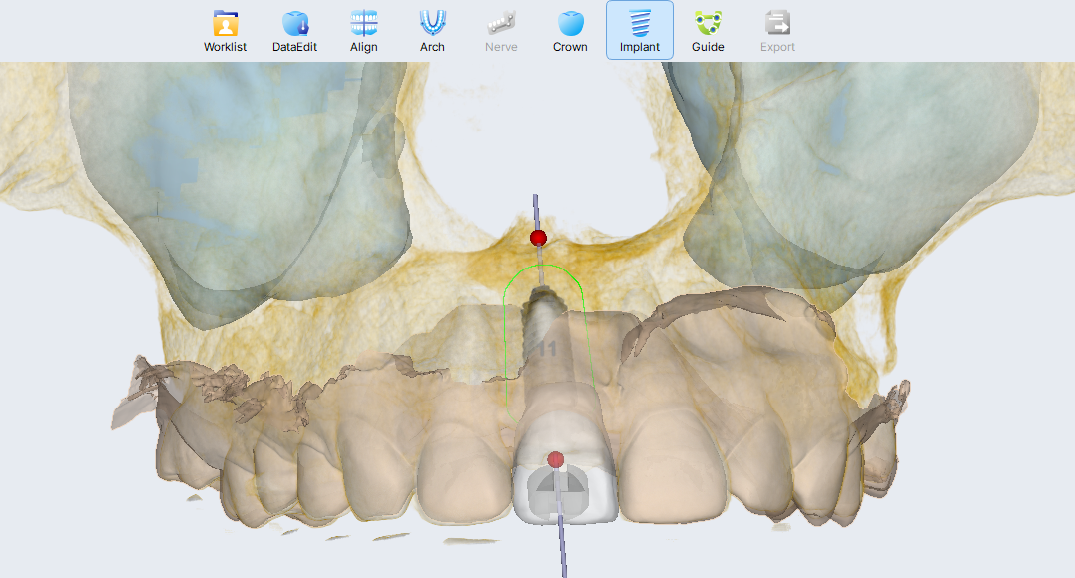R2GATE 네비게이션 임플란트 3D 가이드 · CBCT + 구강 스캔 정합