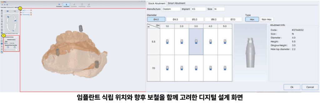 임플란트 식립 위치와 향후 보철을 함께 고려한 디지털 설계 화면