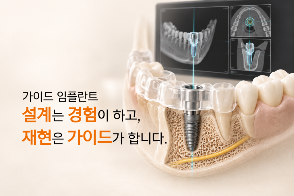 가이드 임플란트의 디지털 설계와 수술용 가이드를 표현한 이미지