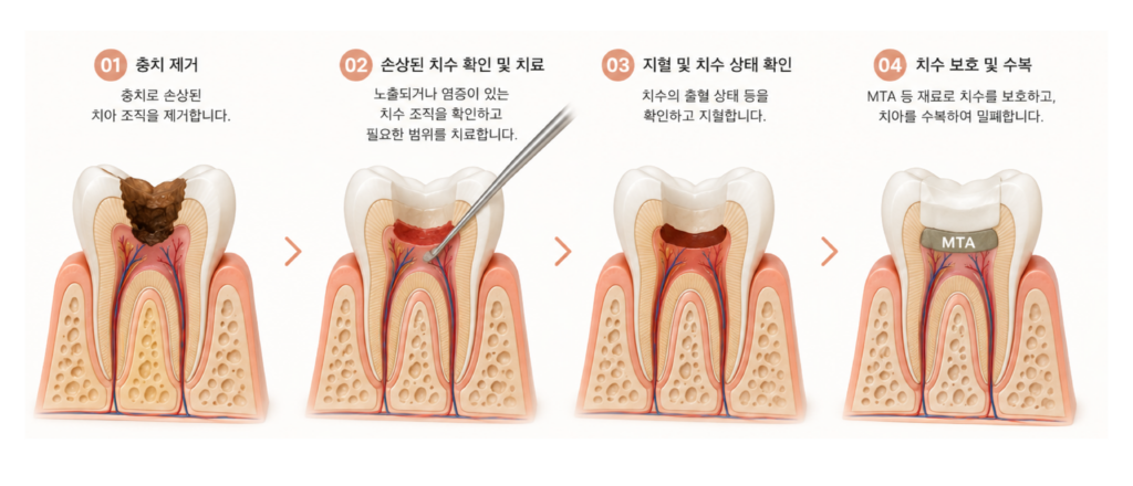 부분 신경치료 VPT의 치료 과정을 단계별로 설명한 이미지