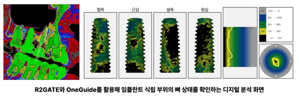 CT 자료를 바탕으로 임플란트 식립 위치와 방향을 계획한 디지털 설계 화면